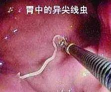 肝脏有18mm多发囊肿有问题吗,肝脏出现6cmx5cm脓肿