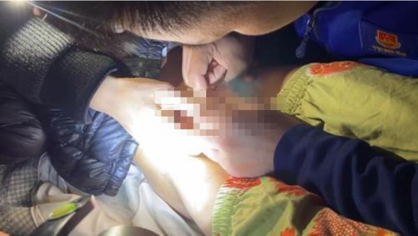 俩月出现两次，拉链咬伤男童*体下**，建议穿松紧带裤减少意外出现