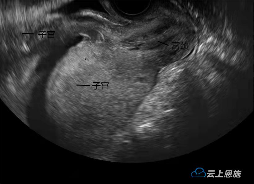 孕妇突发排尿困难恩施州中心医院产科专家：警惕“子宫箝闭”