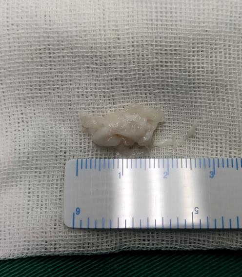 27岁摔成了腰椎间盘突出症,少年腰椎间盘突出怎么治疗