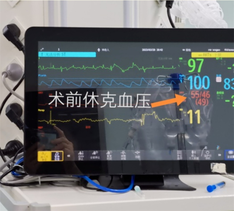 主动脉夹层a型为什么是九死一生,a型主动脉夹层破裂死亡率