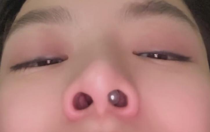 过于自信？女子往鼻孔塞珍珠，结果坏了！