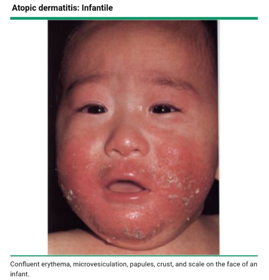 红斑狼疮皮疹的鉴别诊断,系统性红斑狼疮脸上的红斑图片