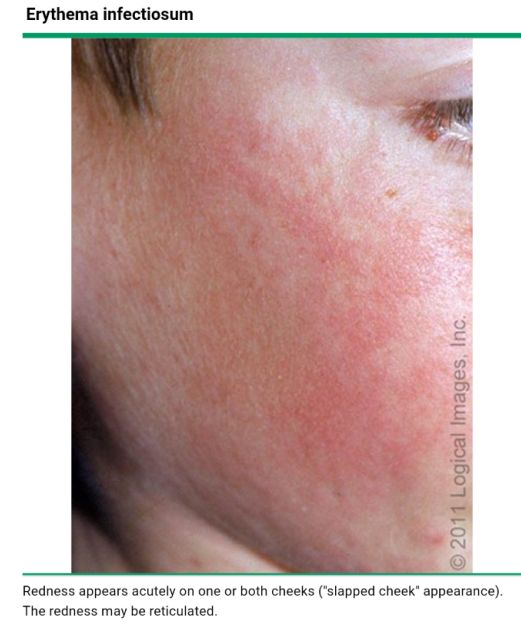 红斑狼疮皮疹的鉴别诊断,系统性红斑狼疮脸上的红斑图片