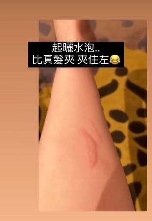 濂虫槑鏄熺儷浼よ吙,濂冲瓙澶辨墜鐑激