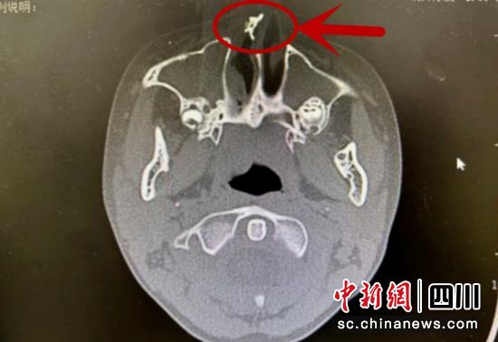 男童慢性鼻炎,成都儿童鼻炎能除根吗