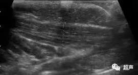 宝宝歪颈和斜颈的症状,婴儿斜颈左侧歪头怎么纠正