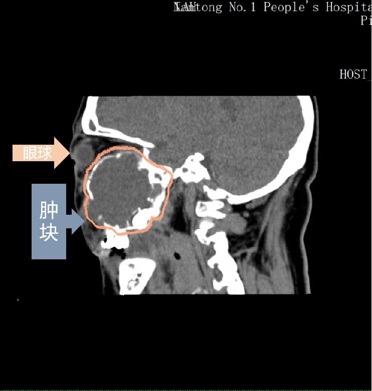 老人眼皮肿块,70岁老人眼睛模糊眼睑里面长颗粒